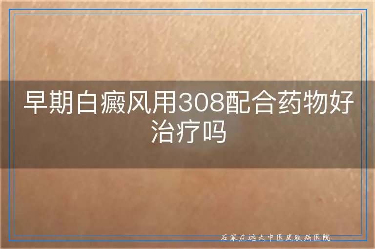 早期白癜风用308配合药物好治疗吗