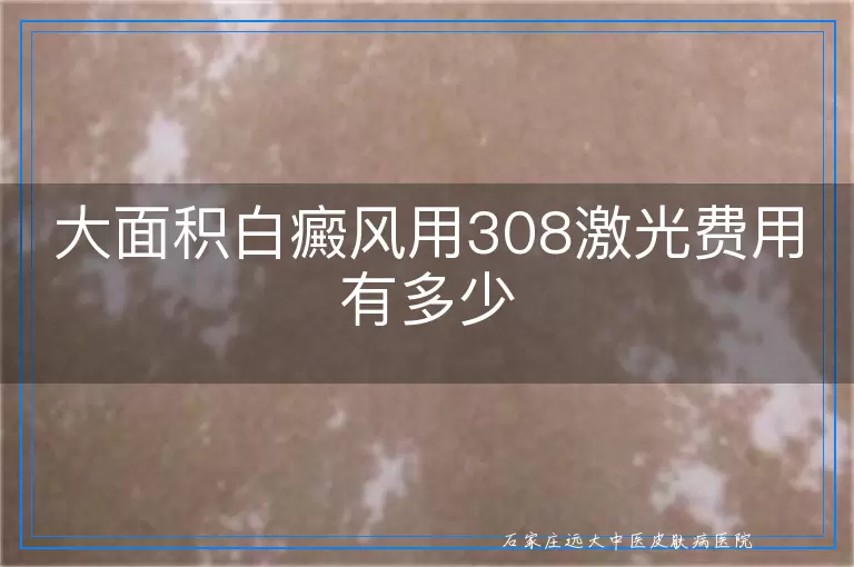 大面积白癜风用308激光费用有多少