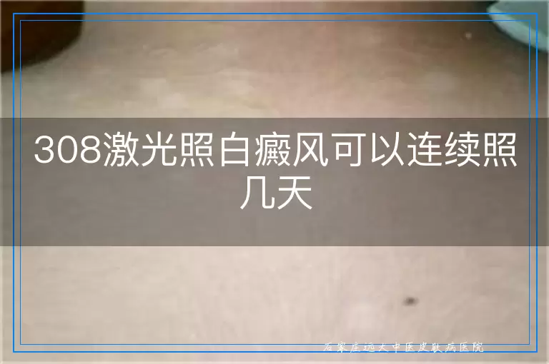 308激光照白癜风可以连续照几天