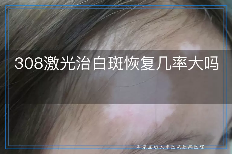 308激光治白斑恢复几率大吗
