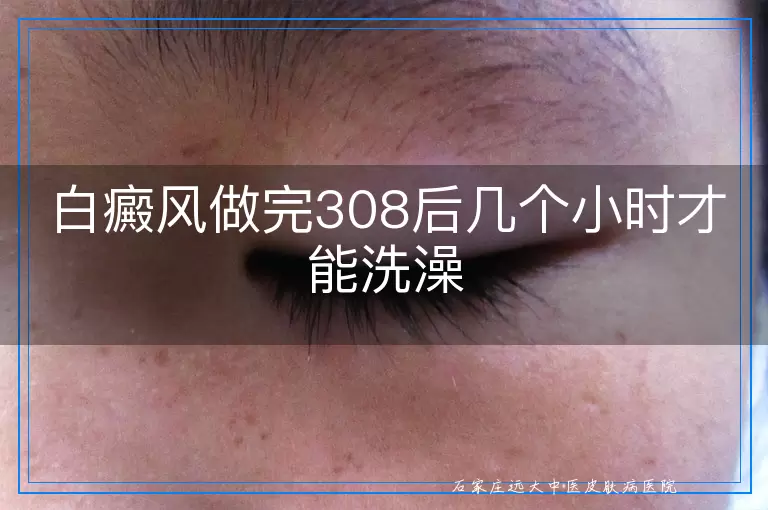 白癜风做完308后几个小时才能洗澡