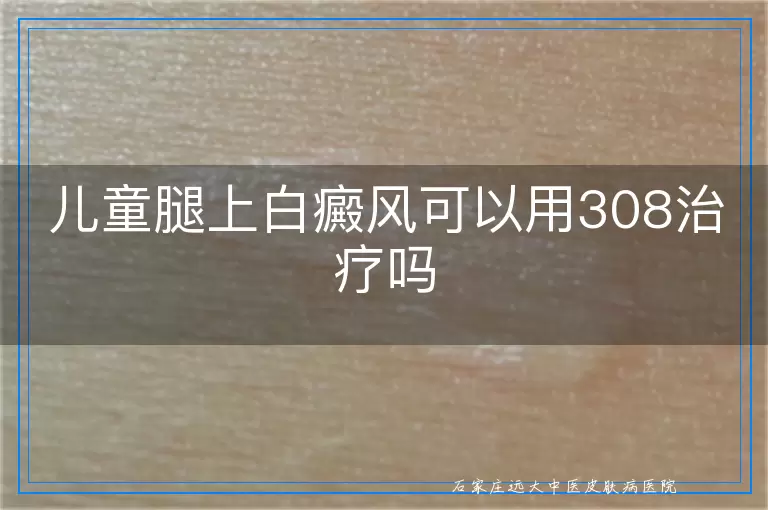 儿童腿上白癜风可以用308治疗吗