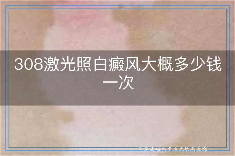 308激光照白癜风大概多少钱一次