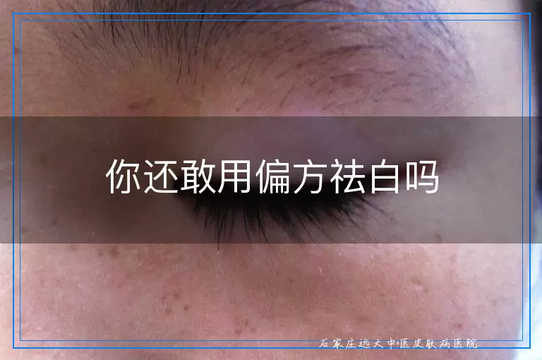 你还敢用偏方祛白吗