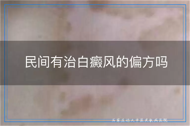 民间有治白癜风的偏方吗
