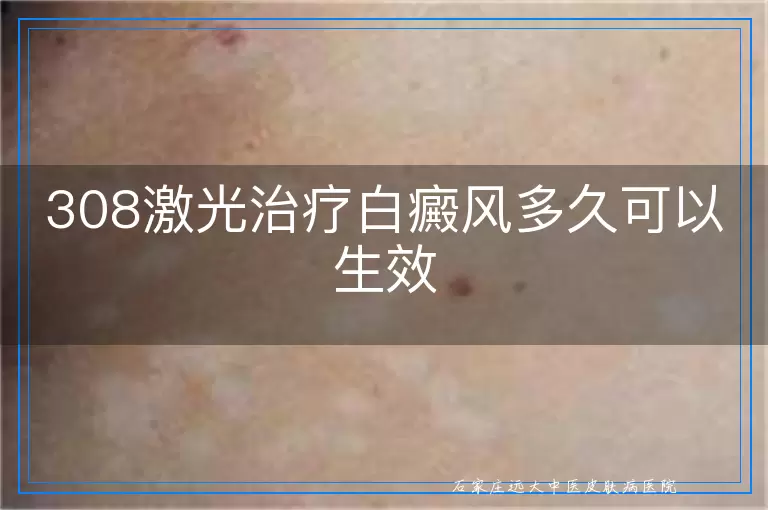 308激光治疗白癜风多久可以生效