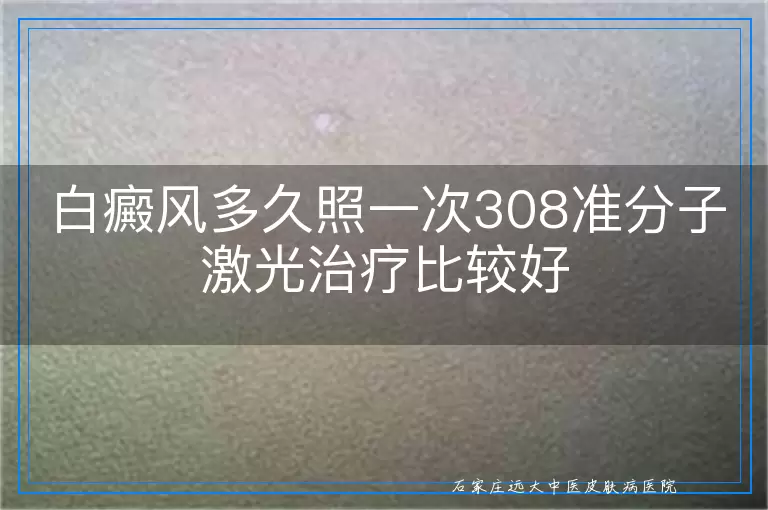 白癜风多久照一次308准分子激光治疗比较好