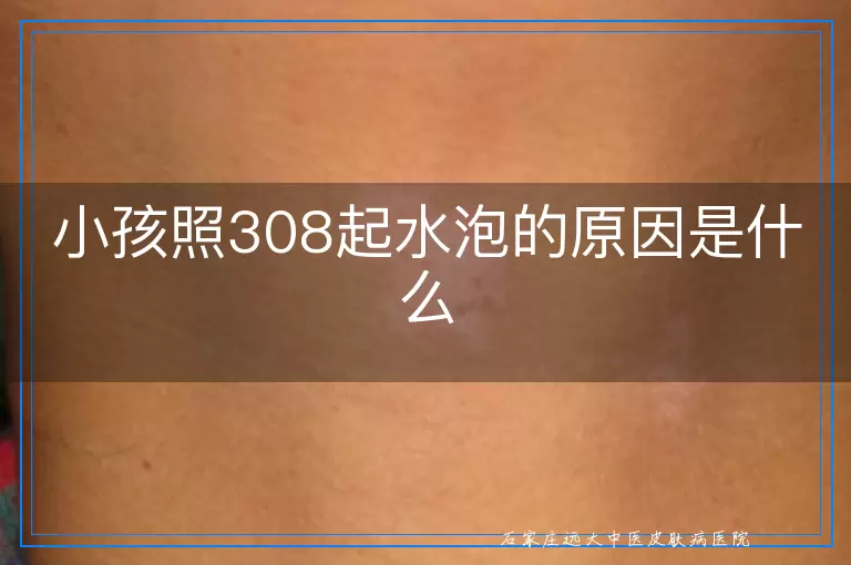 小孩照308起水泡的原因是什么