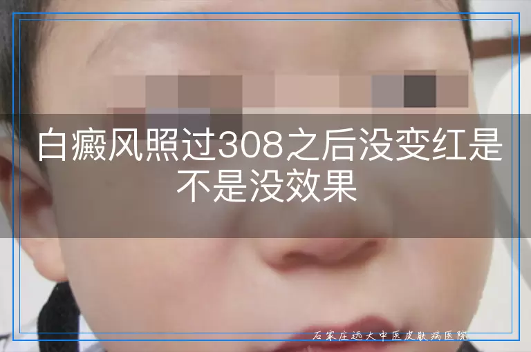白癜风照过308之后没变红是不是没效果