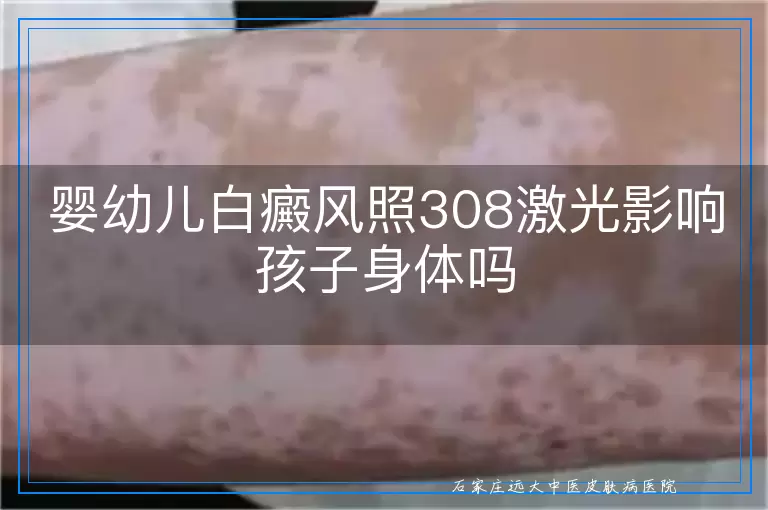 婴幼儿白癜风照308激光影响孩子身体吗