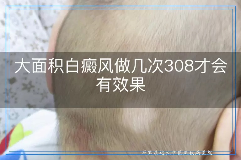大面积白癜风做几次308才会有效果