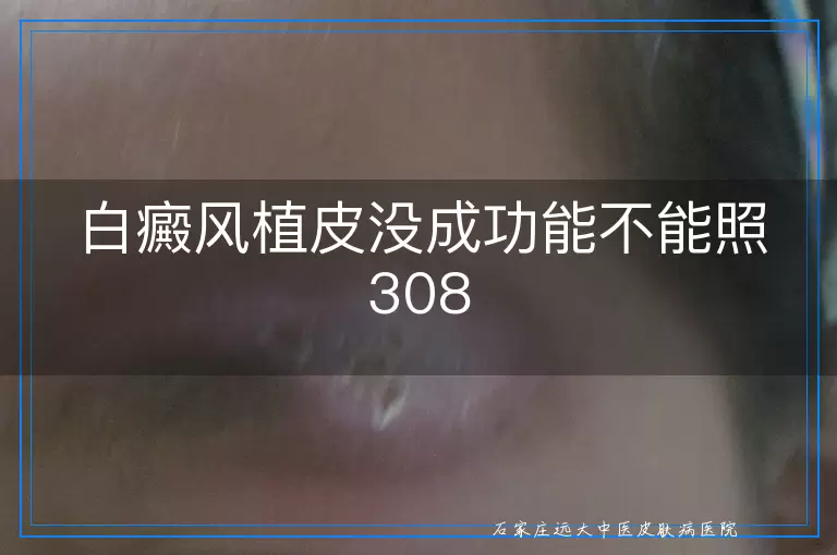 白癜风植皮没成功能不能照308