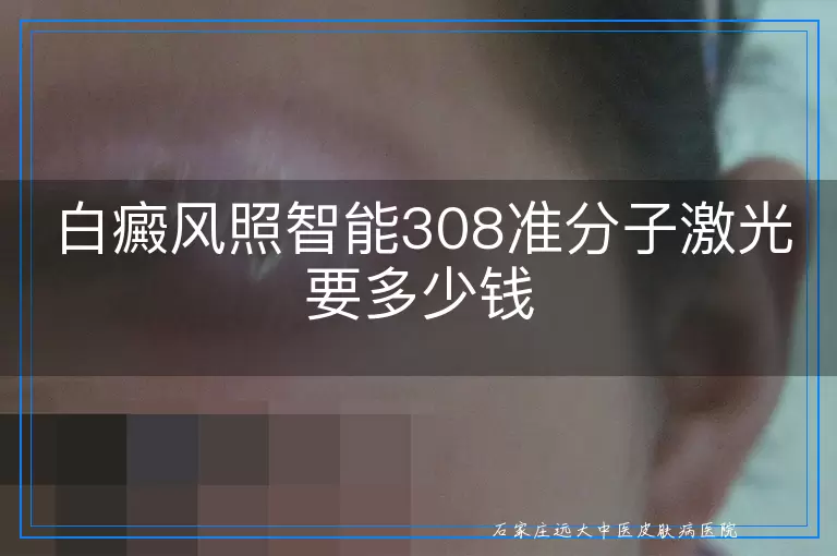 白癜风照智能308准分子激光要多少钱