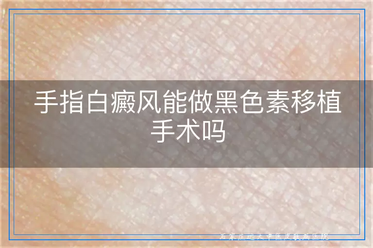 手指白癜风能做黑色素移植手术吗
