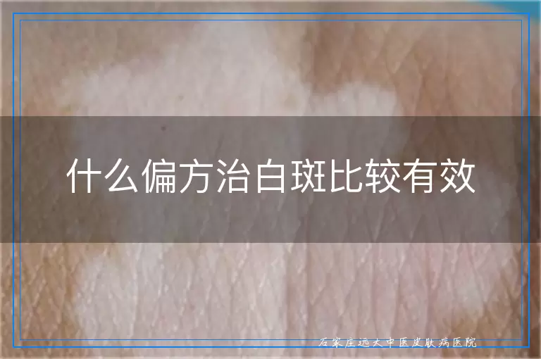 什么偏方治白斑比较有效