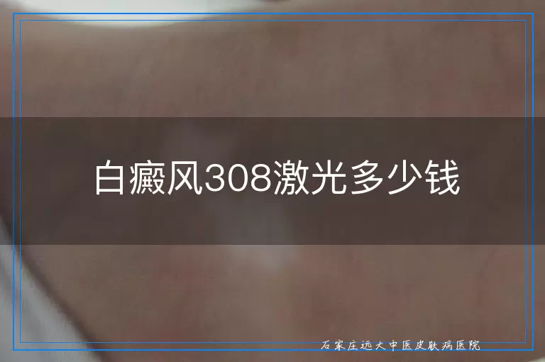 白癜风308激光多少钱