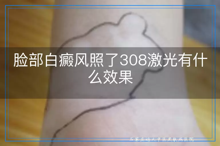 脸部白癜风照了308激光有什么效果