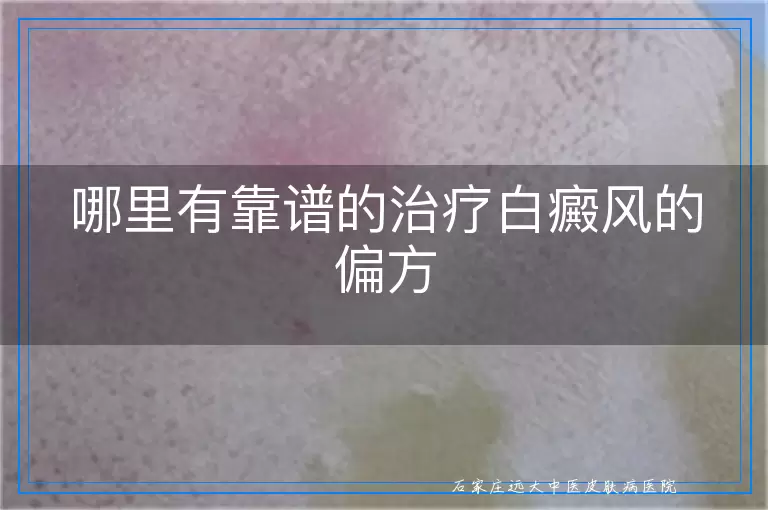 哪里有靠谱的治疗白癜风的偏方