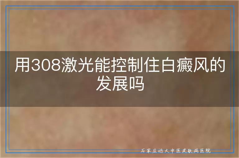 用308激光能控制住白癜风的发展吗