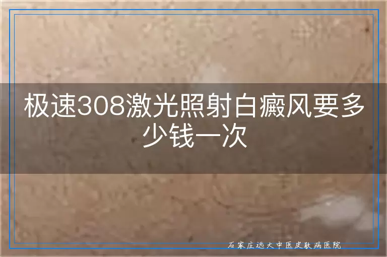 极速308激光照射白癜风要多少钱一次