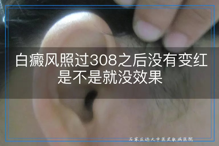 白癜风照过308之后没有变红是不是就没效果