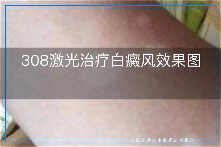 308激光治疗白癜风效果图