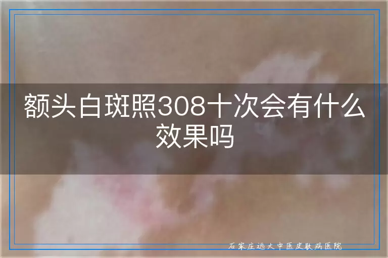 额头白斑照308十次会有什么效果吗