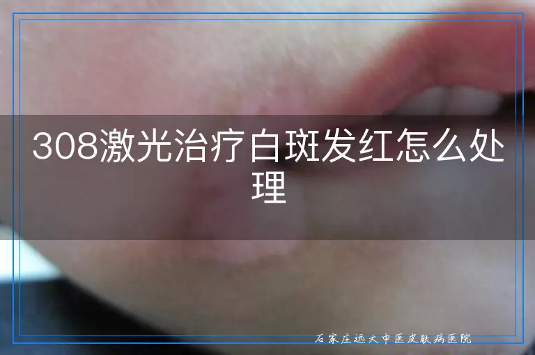 308激光治疗白斑发红怎么处理