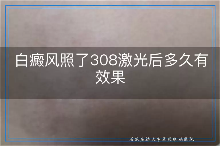 白癜风照了308激光后多久有效果