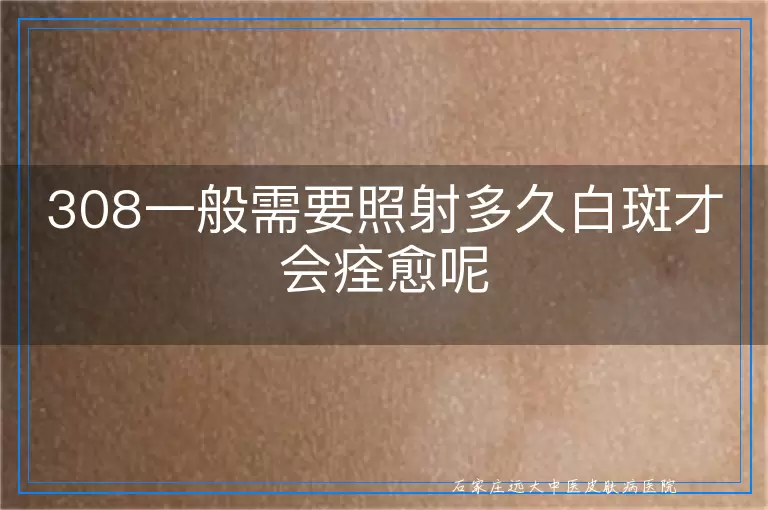 308一般需要照射多久白斑才会痊愈呢