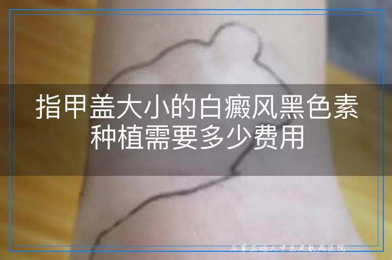 指甲盖大小的白癜风黑色素种植需要多少费用