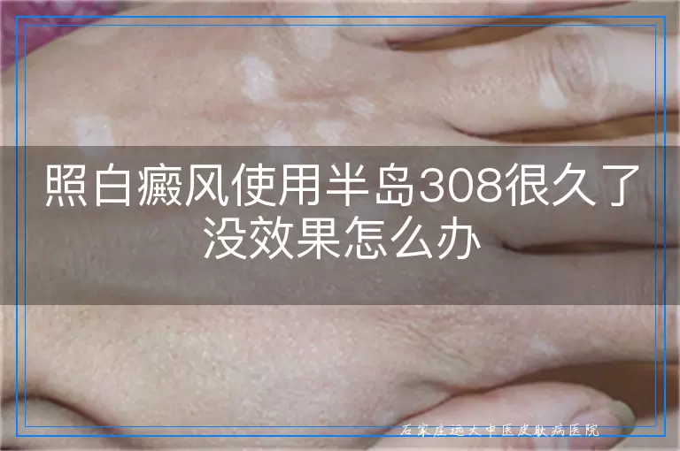 照白癜风使用半岛308很久了没效果怎么办