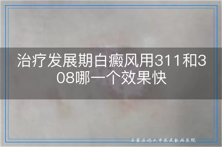 治疗发展期白癜风用311和308哪一个效果快