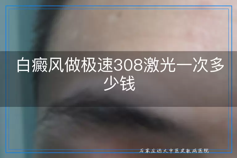 白癜风做极速308激光一次多少钱
