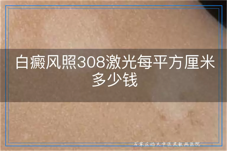白癜风照308激光每平方厘米多少钱