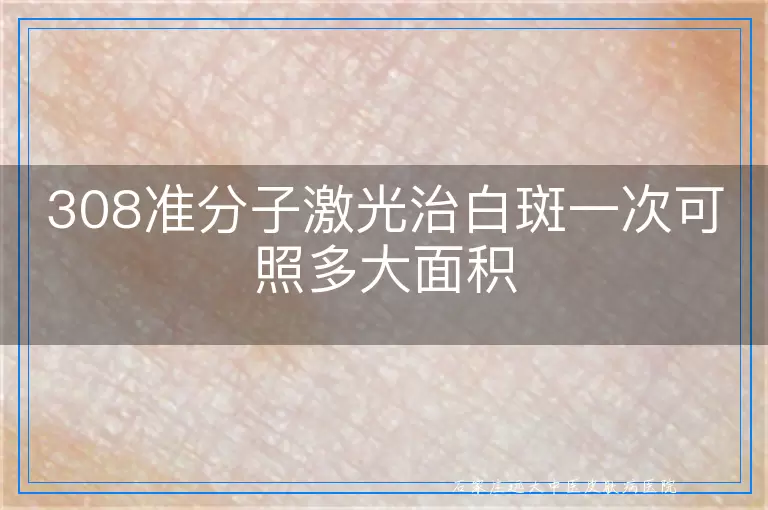 308准分子激光治白斑一次可照多大面积