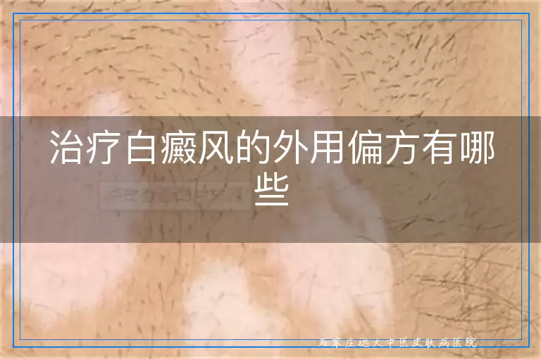 治疗白癜风的外用偏方有哪些