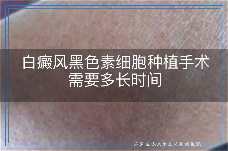 白癜风黑色素细胞种植手术需要多长时间