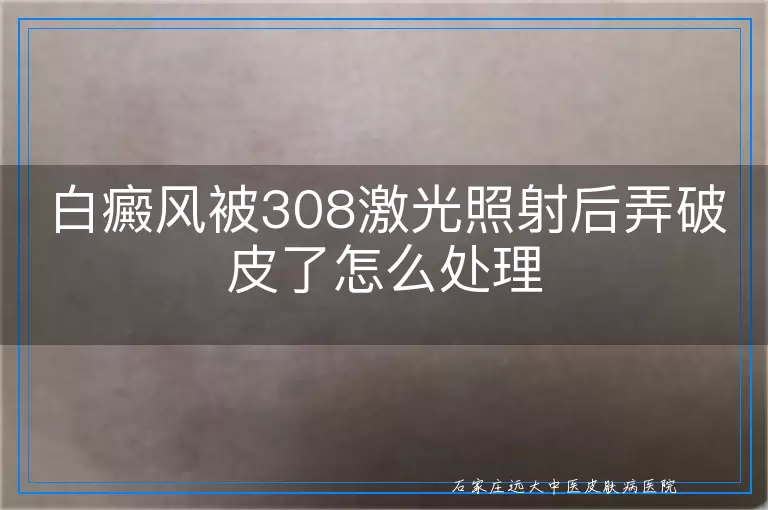 白癜风被308激光照射后弄破皮了怎么处理