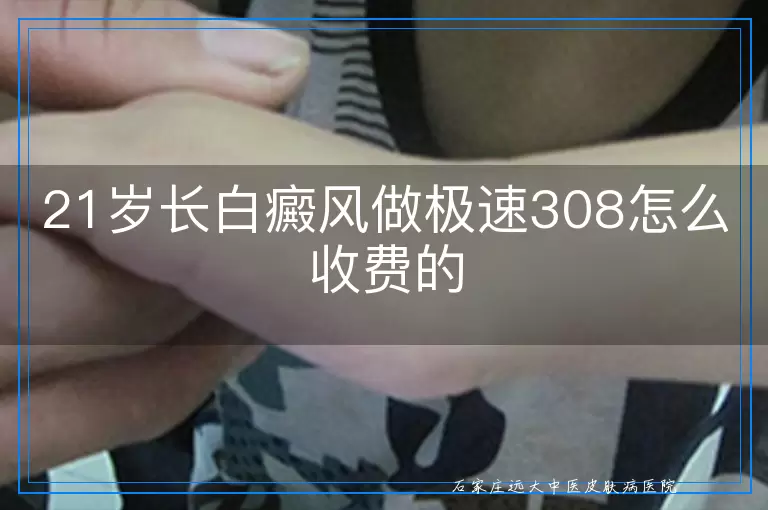 21岁长白癜风做极速308怎么收费的
