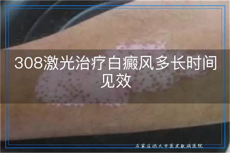 308激光治疗白癜风多长时间见效