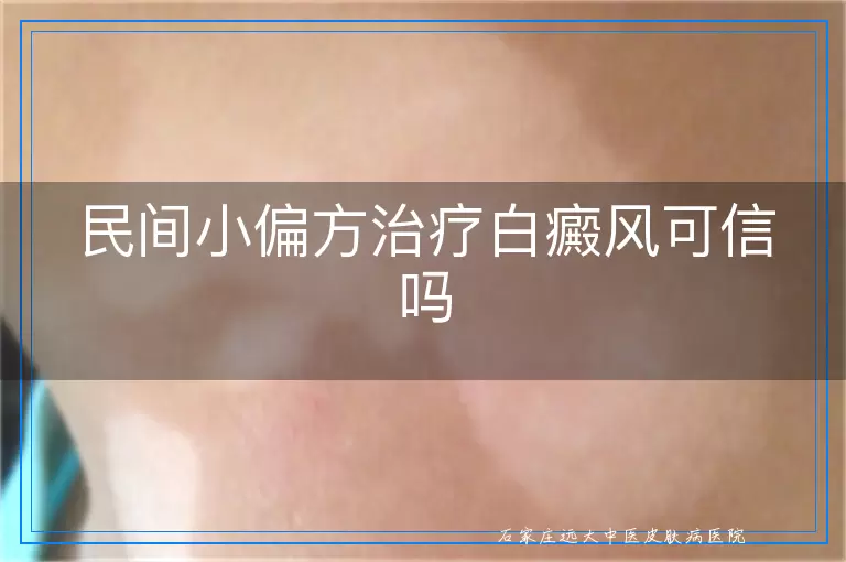 民间小偏方治疗白癜风可信吗
