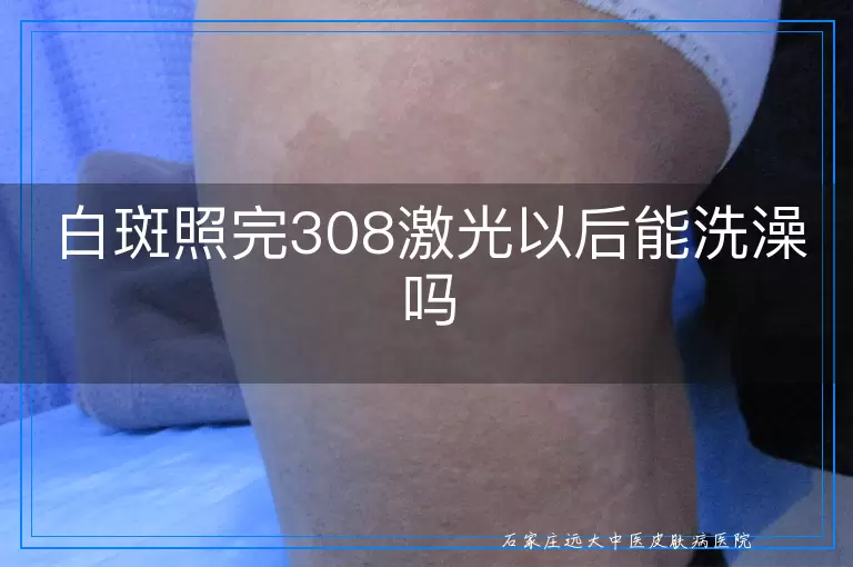白斑照完308激光以后能洗澡吗