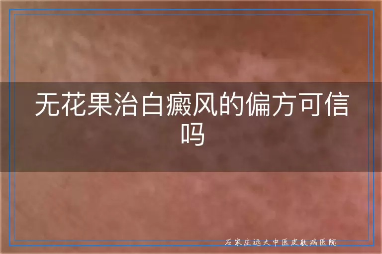 无花果治白癜风的偏方可信吗