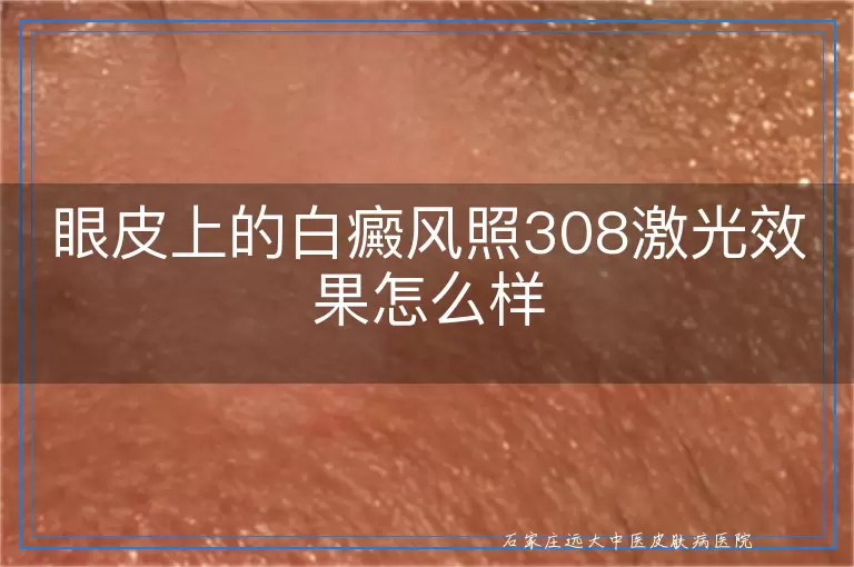 眼皮上的白癜风照308激光效果怎么样