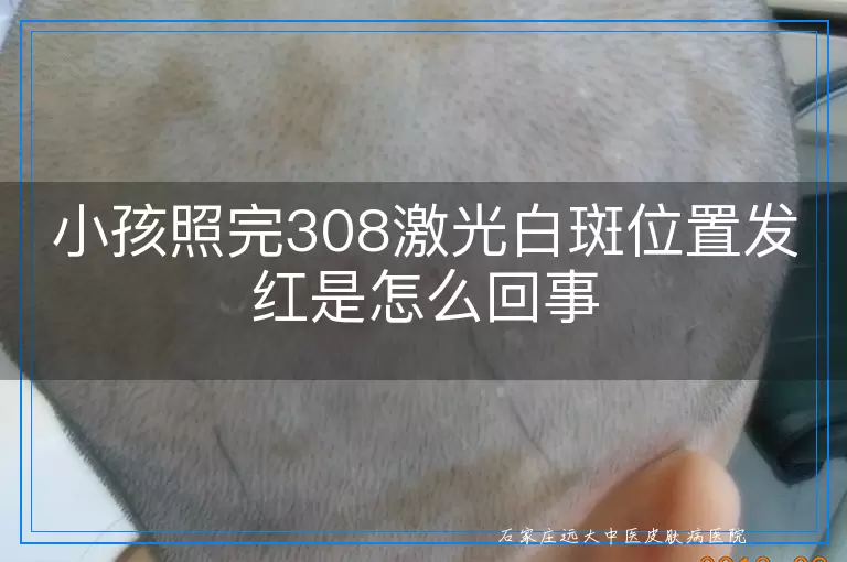 小孩照完308激光白斑位置发红是怎么回事