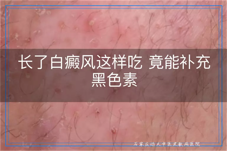 长了白癜风这样吃 竟能补充黑色素