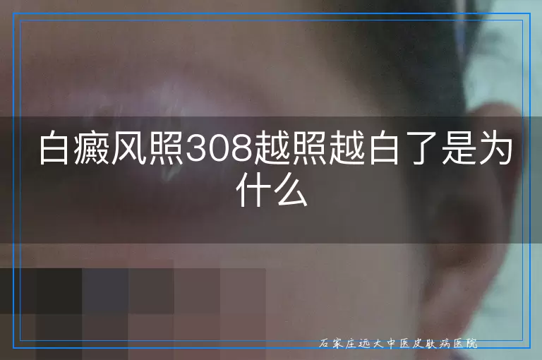 白癜风照308越照越白了是为什么