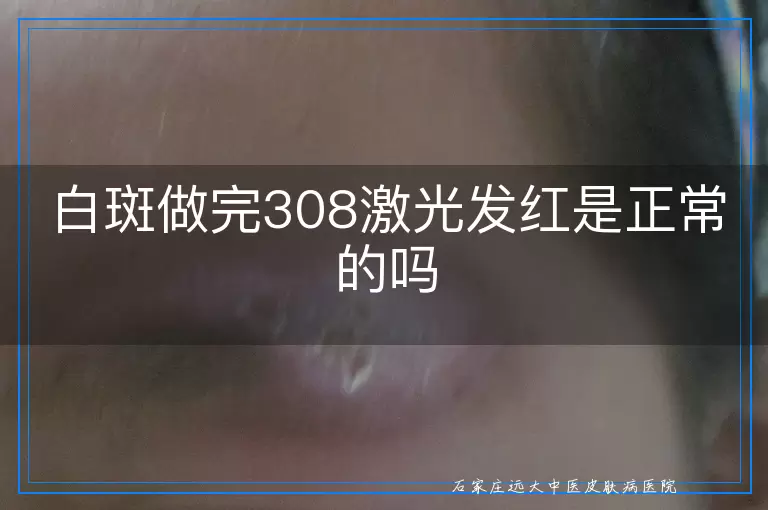 白斑做完308激光发红是正常的吗