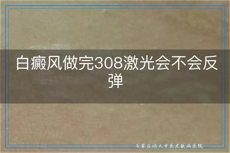 白癜风做完308激光会不会反弹